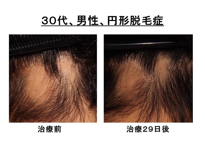 円形脱毛症　病院""